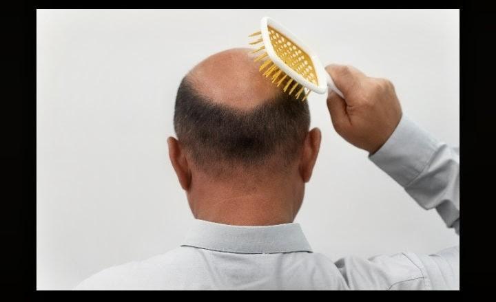 When Family History Catches Up: Treating Hereditary Balding