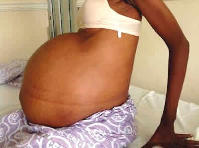 Why virginity does not protect against fibroids