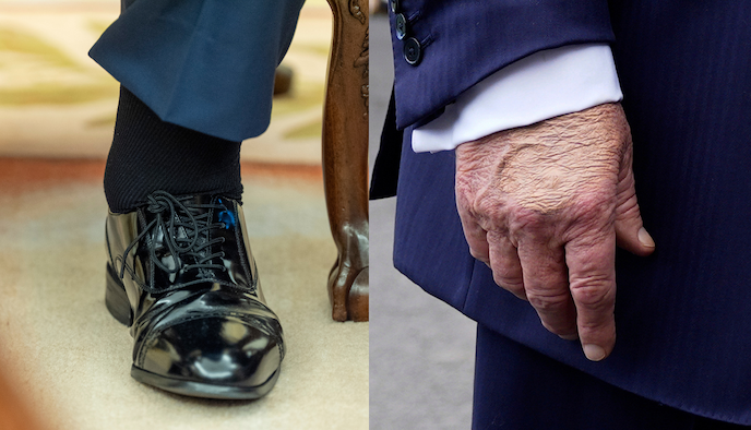 White House Doctor Says Trump Fit For Duty Despite Leg Swelling, Hand Bruising